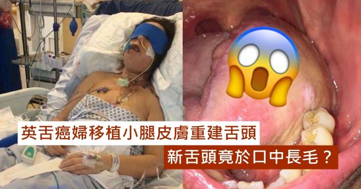 英舌癌婦移植小腿皮膚重建舌頭口中竟長毛？