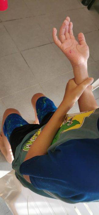 男童帶鑊鏟沙灘掘沙 用力過度皮肉竟攝入鐵縫